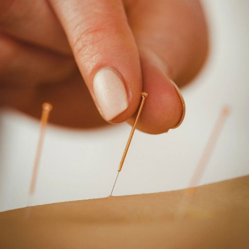 Acupuntura